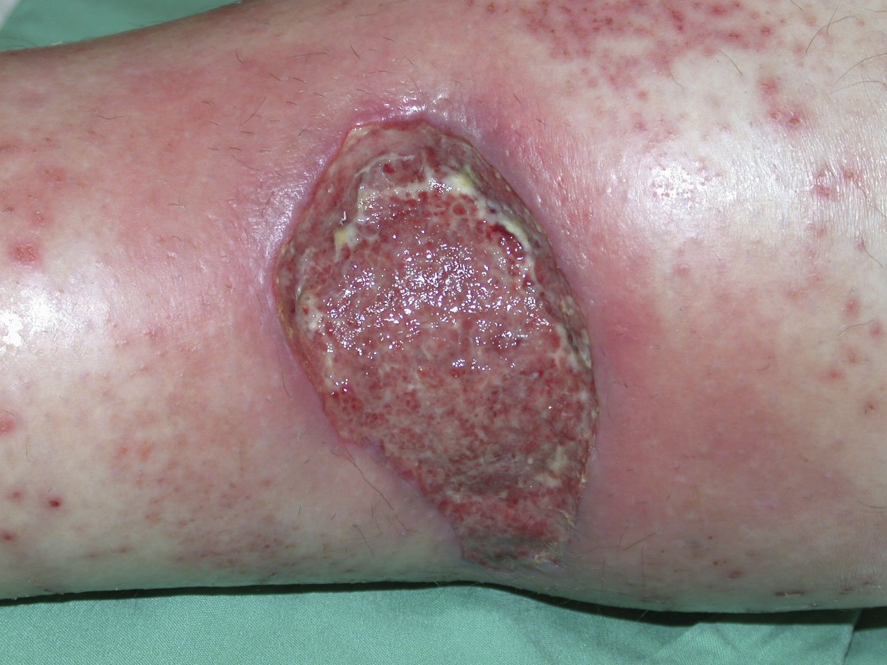 Antiinf.wirk.Verb. Schaum1li Infiziertes Ulkus an der Wade