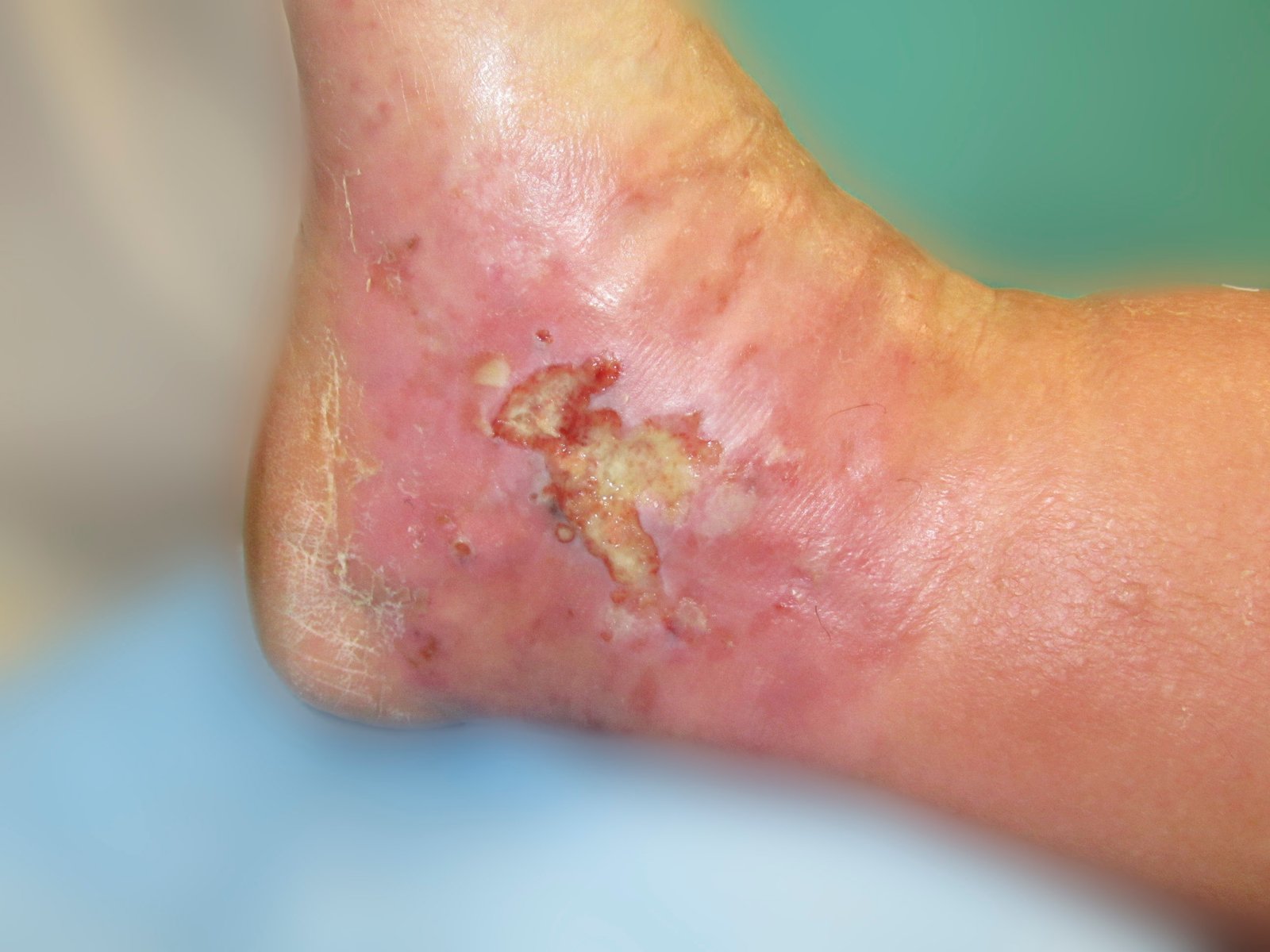 Antiinf.wirk.Verb. Schaum2re Infiziertes Ulcus cruris arteriosum