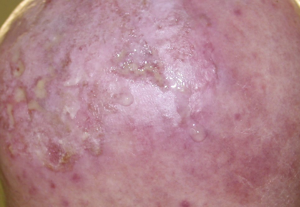 Antiinf.wirk.Verb. Wundgaze2re Infizierte oberflächliche Ulzerationen am Kopf