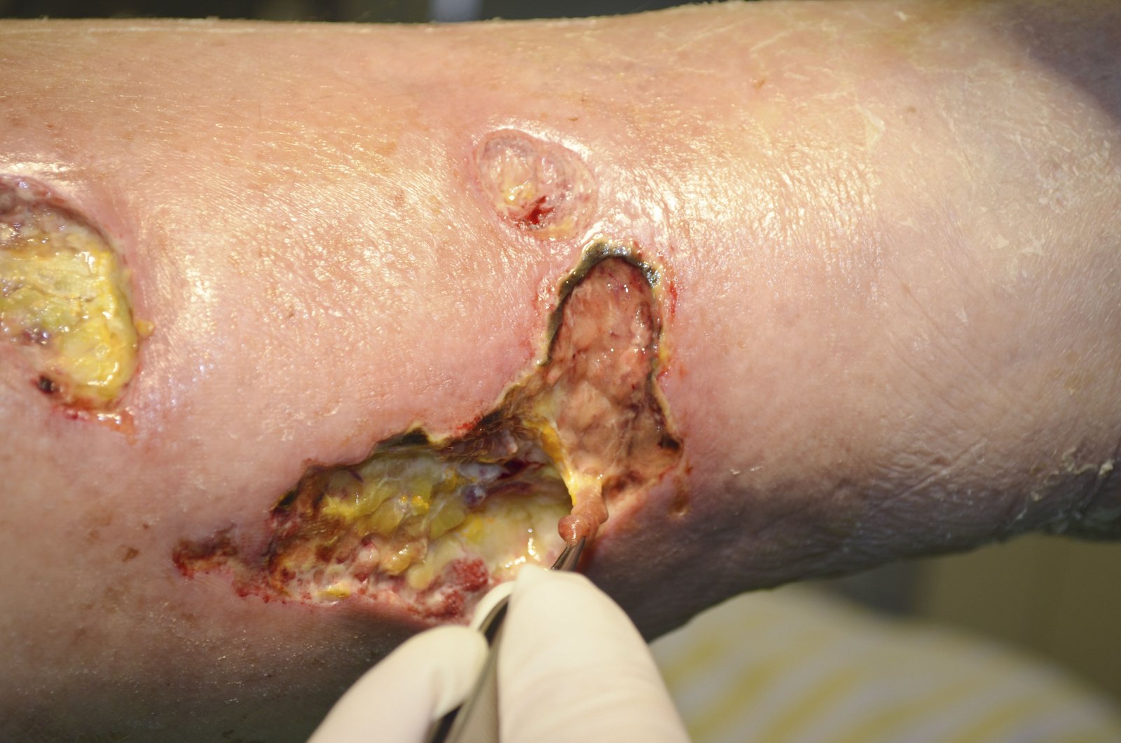 Antiseptika2 re Abszedierende Weichteilinfektion am Oberschenkel