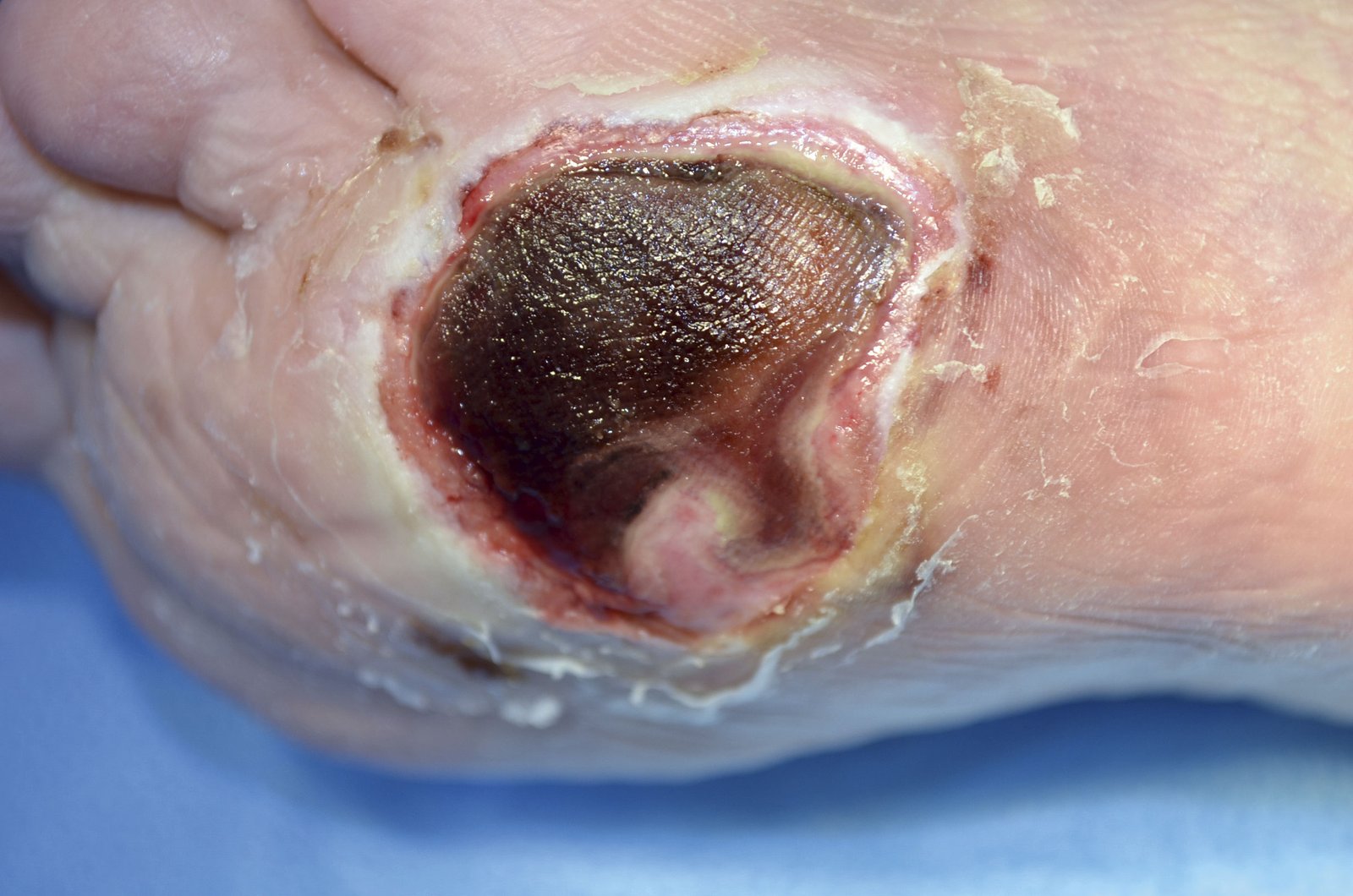 Hydroakt.Gele2re Nekrose an der Fußsohle vor autolytischer Therapie