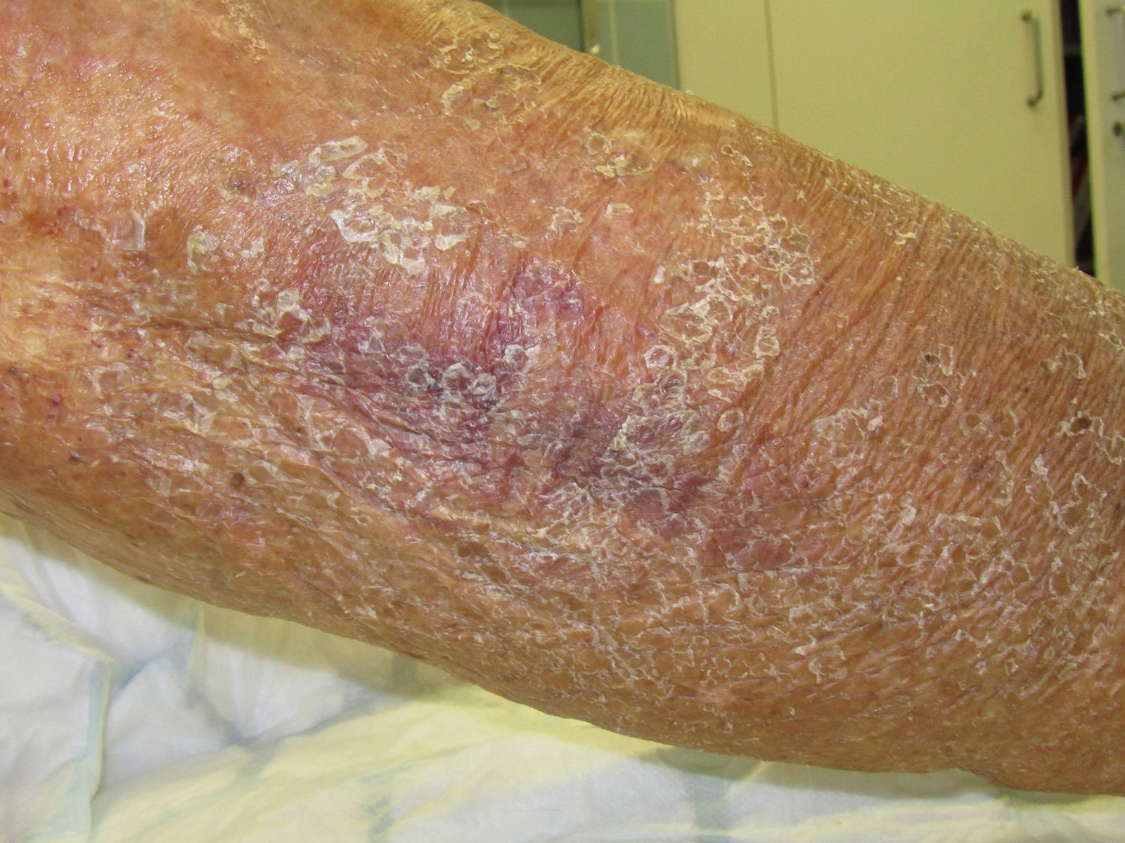 Med.Hautschutz1li Trockene Haut bei abgeheiltem Ulkus