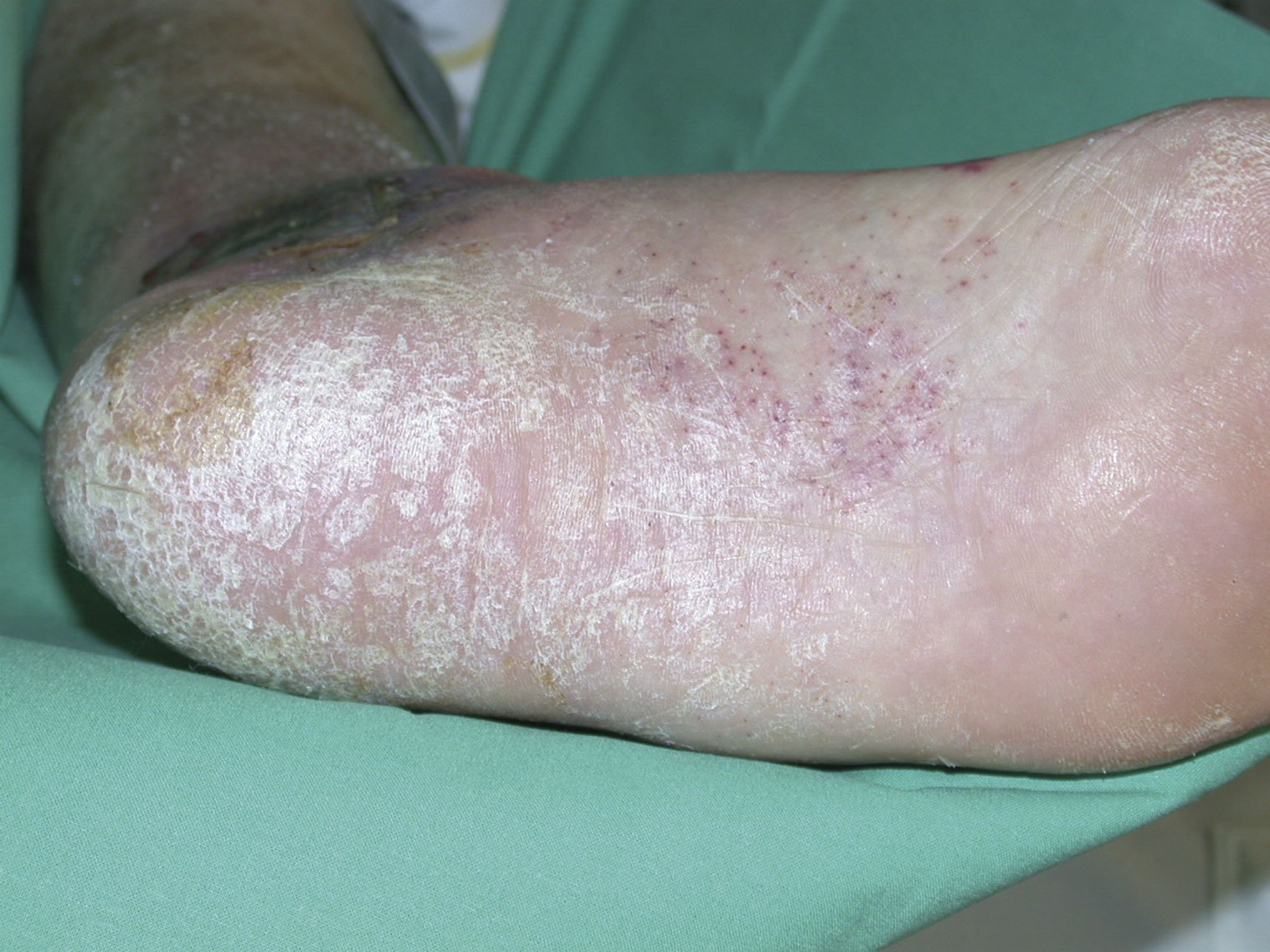 Med.Hautschutz2re Ungepflegte trockene Haut an der Ferse beim Diabetiker