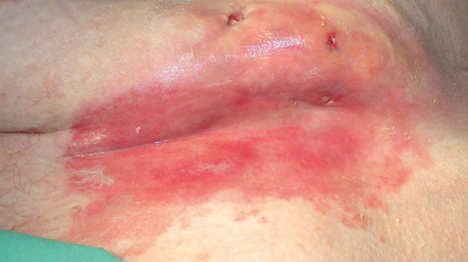 Antibakt. Textil1 li Intertrigo im Bereich der Bauchfalte