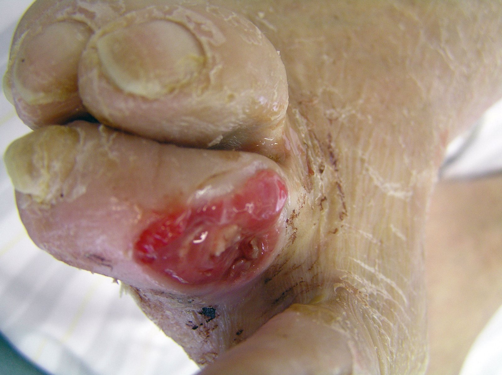 Antiinf.wirk.Verb. Wundgaze1li Kolonisierte Druckstelle an der 2. Zehe