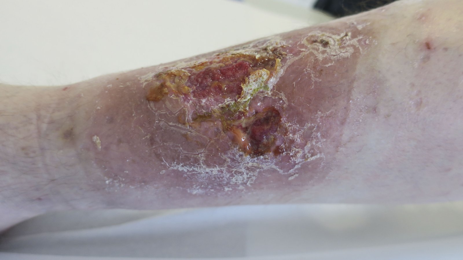 Antiseptika1 li Infizierte Wunde am Unterschenkel nach Hauttransplantation