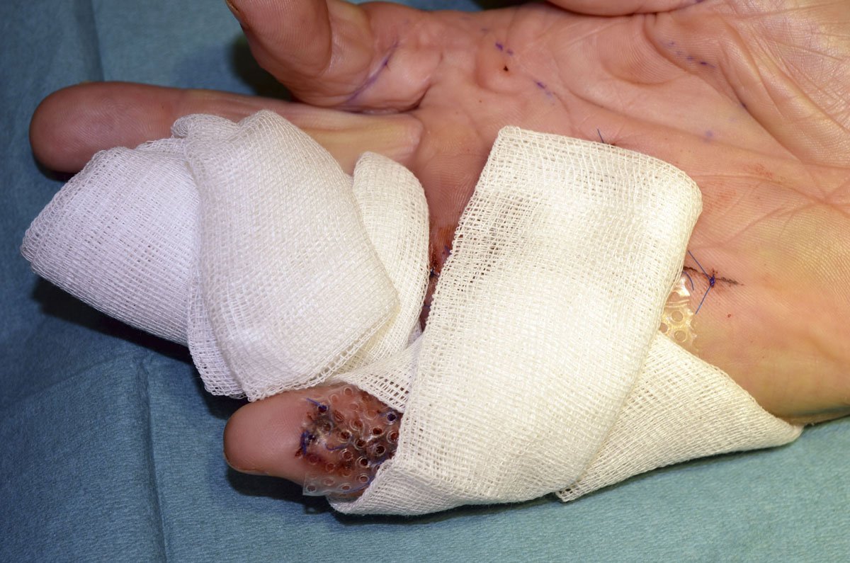 Fixier2re Postoperativer Kompressionsverband vor Fixierung