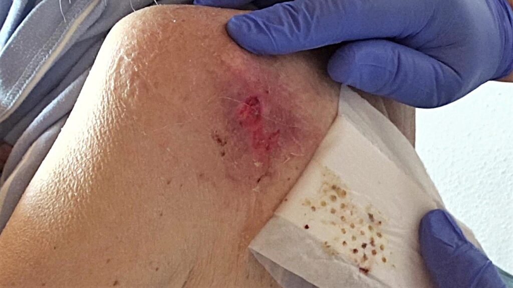 Oberflächliche Druckstelle an der Schulter bei kachektischer Patientin. Erstversorgung mit Cosmopor silicone